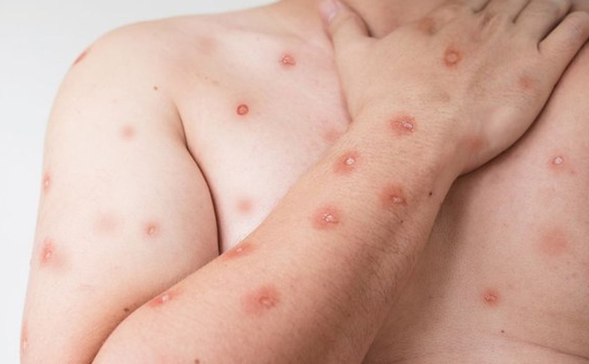 Mpox: entenda por que é difícil avaliar o perigo da doença