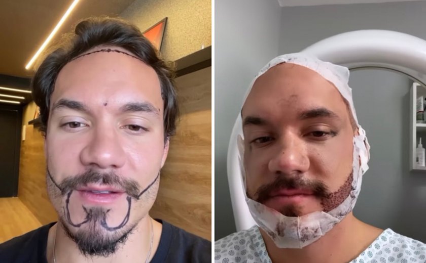 Ex-BBB Eliezer realiza transplante de cabelo e barba para ‘corrigir falhas’