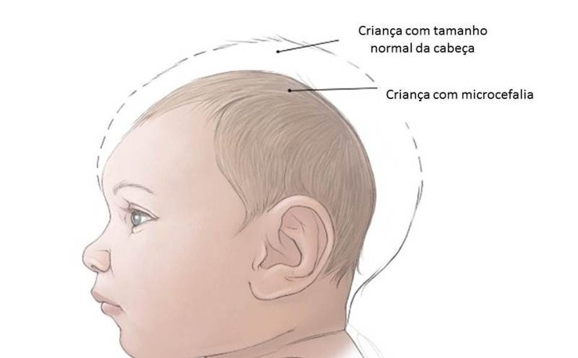 SP registra 2 casos de microcefalia que podem ter relação com zika vírus