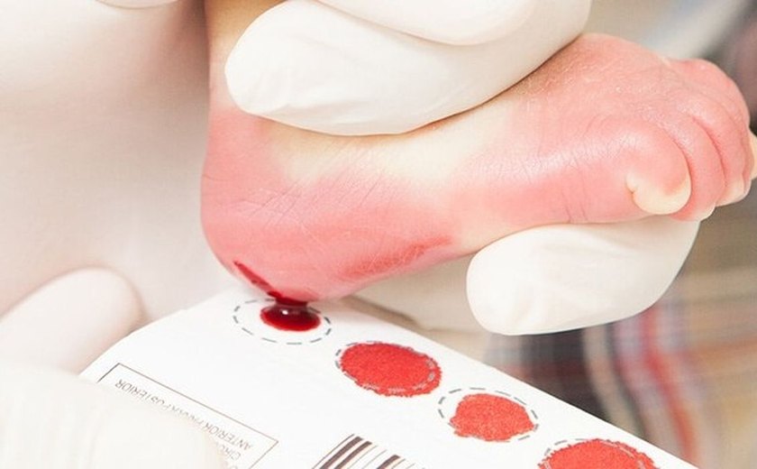 Teste do Pezinho é fundamental no diagnóstico precoce de doenças raras