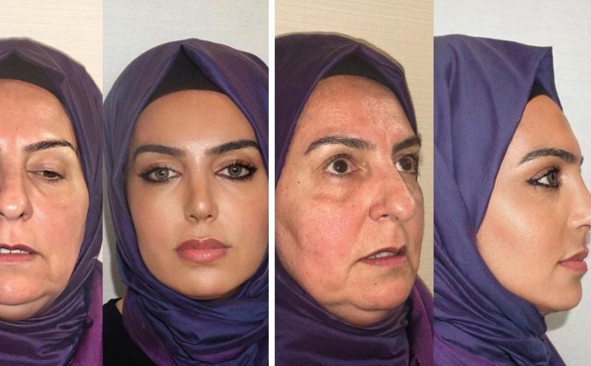 Antes e depois de cirurgia plástica em mulher de 68 anos viraliza
