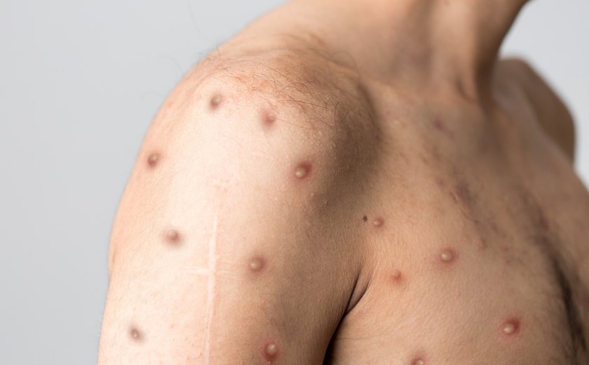 Sintomas, gravidade, transmissão por sexo, vacina: especialistas tiram as dúvidas sobre a nova cepa mais letal da Mpox