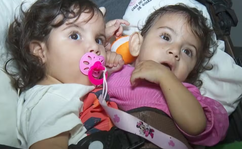 Kiraz, uma das gêmeas siamesas separadas em cirurgia complexa em Goiás, morre aos 1 ano e 6 meses