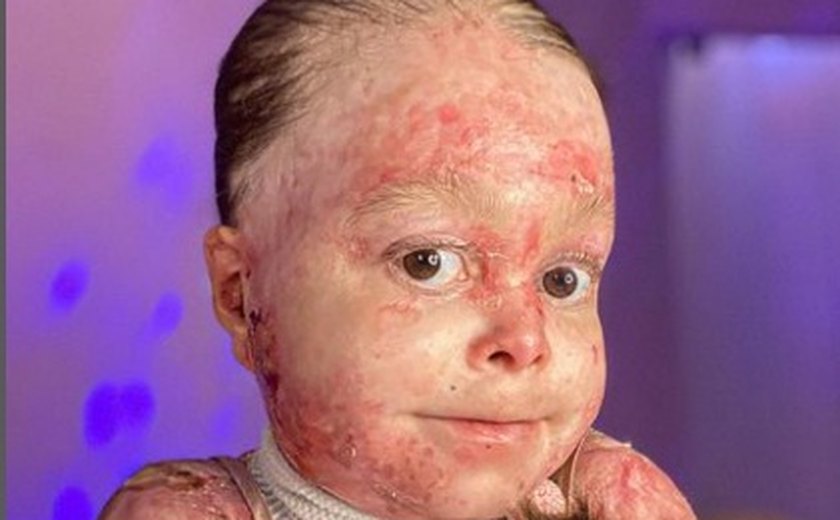 Epidermólise bolhosa: influenciadora que convive com bolhas no corpo compartilha sua rotina