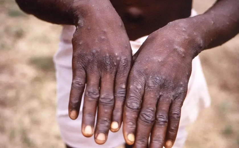 Brasil ultrapassa 1 mil casos de mpox e supera total de registros de 2023