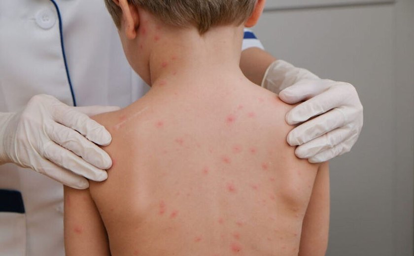 Meningite meningocócica: saiba o que é a doença e como prevenir