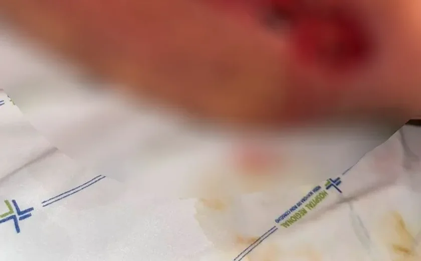 Dentista é presa em Arapiraca por aplicar silicone industrial e causar lesões graves em pacientes
