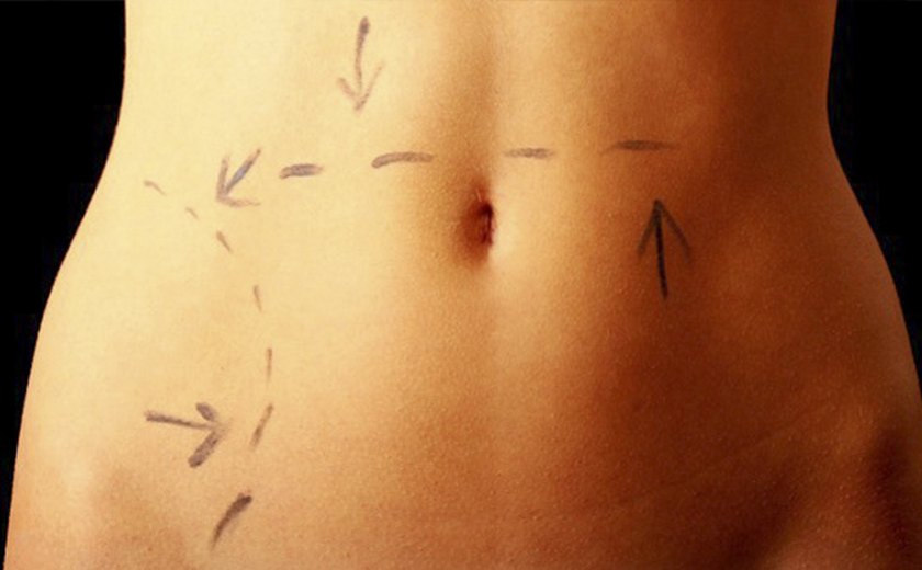 Cirurgias plásticas pós-parto são recomendáveis?