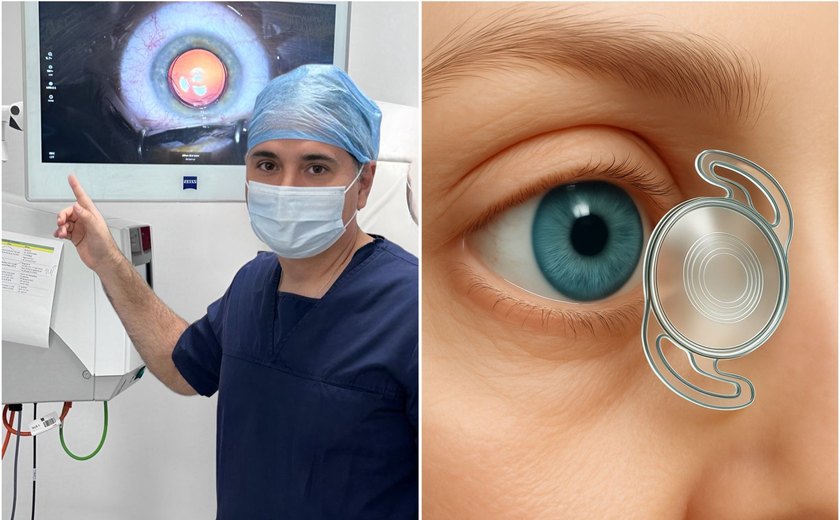 Lente intraocular criada por médico alagoano chega ao Brasil e promete revolucionar cirurgias de catarata