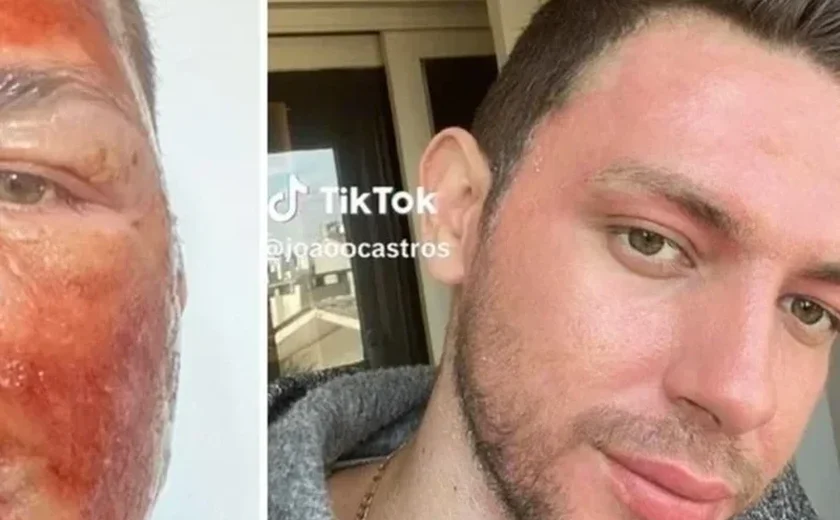 Peeling de fenol: influencer não tinha capacitação para fazer curso, diz farmacêutica