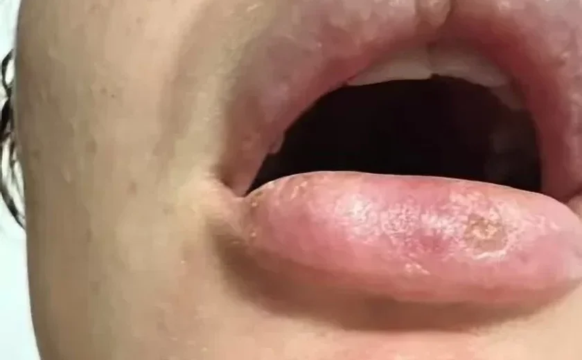 Mulher de 24 anos sofre reação alérgica extrema após aplicação de preenchimento labial