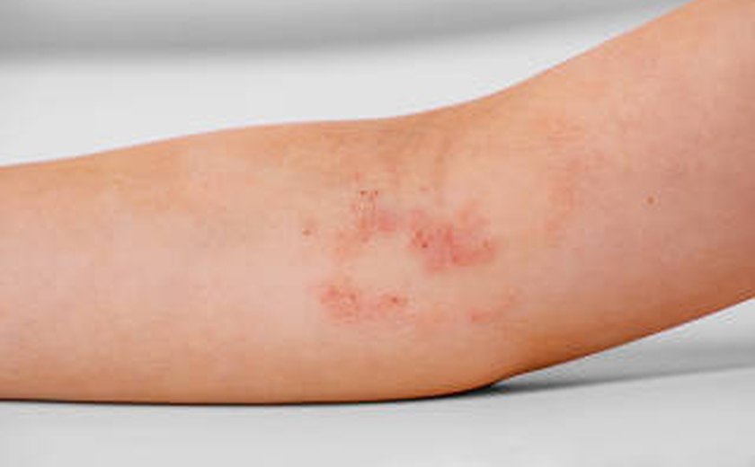 Pesquisa usa IA para tirar dúvidas sobre dermatite atópica
