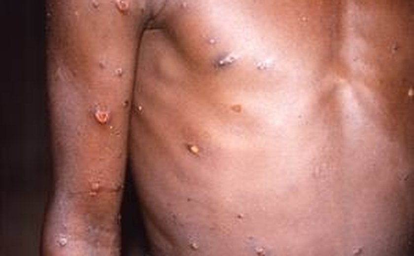 OMS recoloca mpox, antiga varíola dos macacos, como uma emergência global