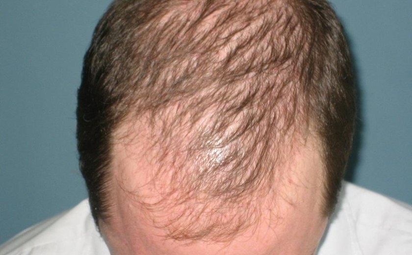 'Ser careca será uma escolha': dermatologista fala dos novos tratamentos para calvície