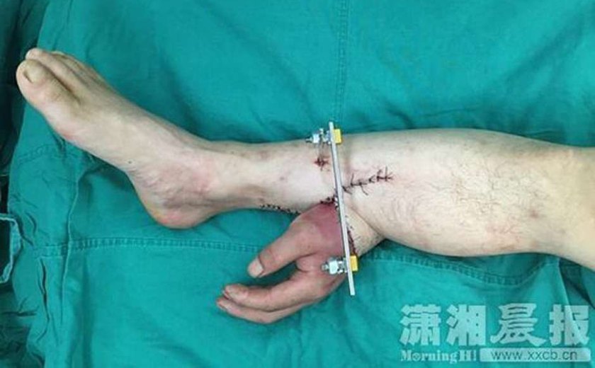 Homem tem mão decepada e médicos a enxertam no tornozelo