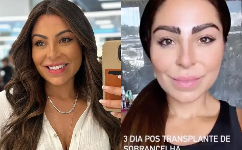 Transplante de sobrancelha: entenda como funciona o procedimento feito pela mulher de Thammy Miranda