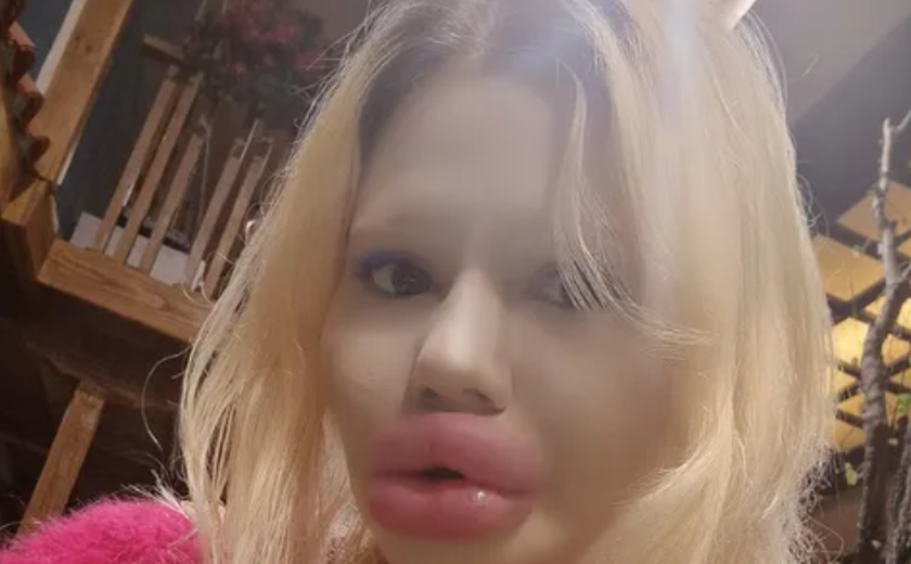 Mulher com maiores lábios do mundo diz que dentistas não querem atendê-la