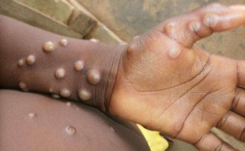 Mpox: qual a letalidade da nova cepa?