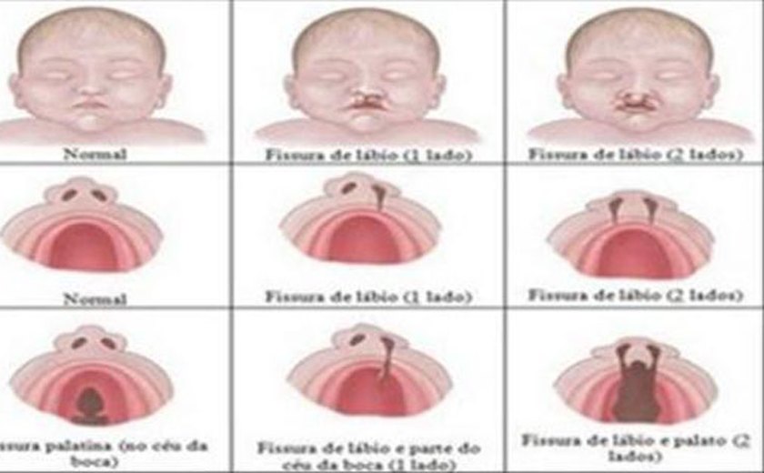 Criança consegue cirurgia para reparo de lábio leporino e fenda palatina