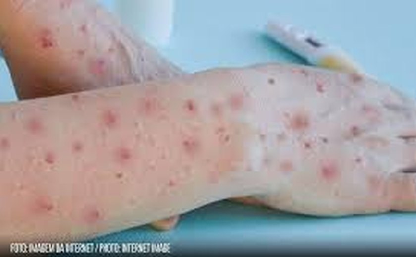 Mpox: EUA alertam para o ressurgimento de uma versão mais mortal da infecção