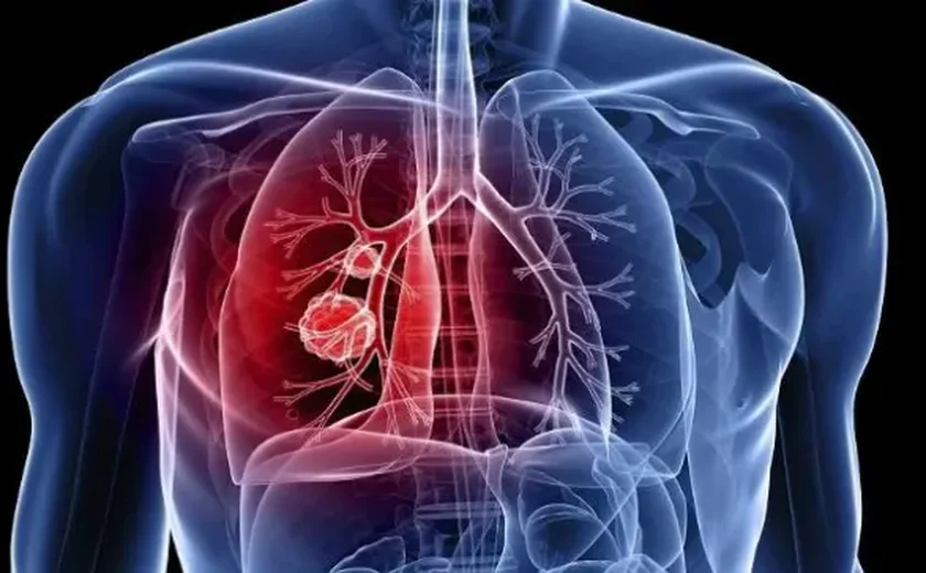 Tuberculose: sintomas, causas e tratamento