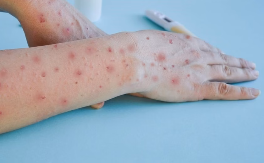 De onde vem a mpox?