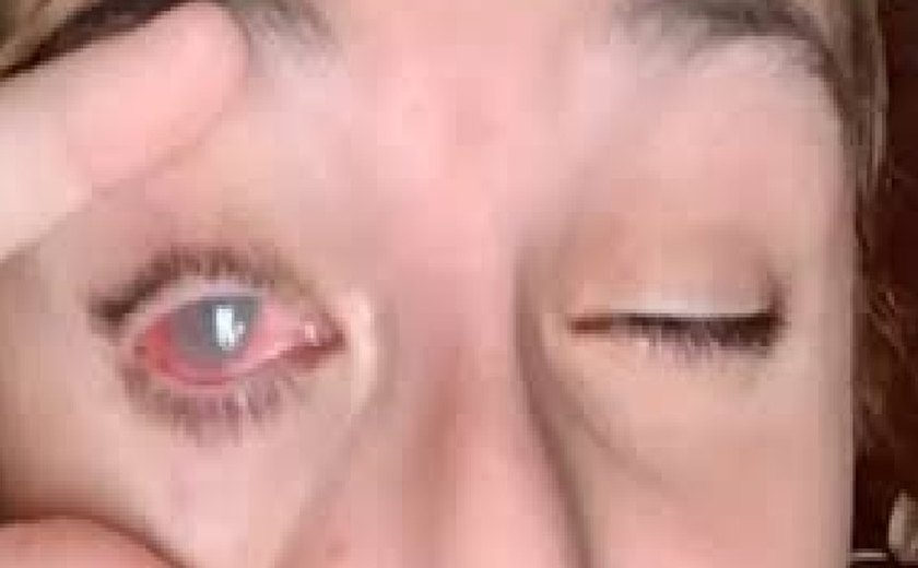 Mulher afirma que 'quase ficou cega’ após detergente atingir seus olhos em acidente no trabalho