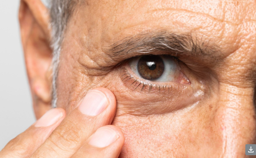 Retinopatia diabética, complicação do diabetes que pode causar cegueira