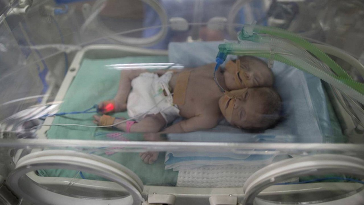 Bebês siameses nascem em hospital palestino