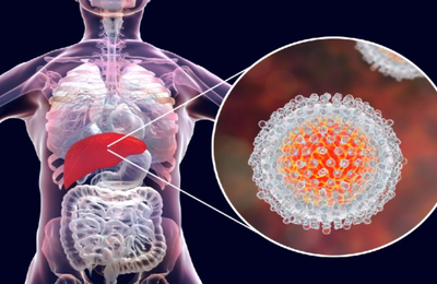 Julho Amarelo: novo teste da Roche Diagnóstica ajuda a reduzir em quatro semanas diagnóstico de hepatite C