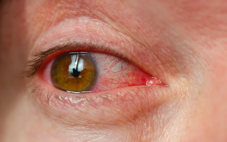 Olhos ardendo e visão embaçada? Tempo seco pode estar por trás do problema