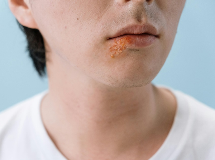 Xô sapinho: 6 dicas de saúde bucal para curtir a folia de Carnaval com segurança