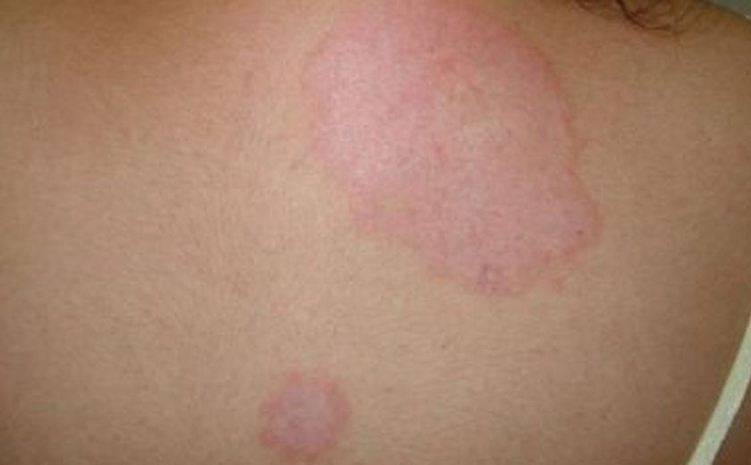 Alagoas registra alta de casos de Hanseníase