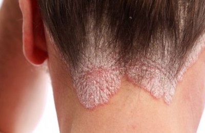 Dia Mundial da Psoríase: Diversos mitos ainda rondam a doença, afirma dermatologista