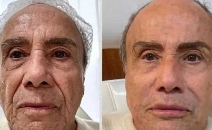 Stênio Garcia aparece com novo rosto após harmonização facial
