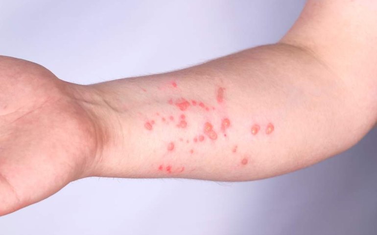 Mpox: tudo o que se sabe sobre a nova cepa mais letal que se dissemina e acende o alerta da OMS