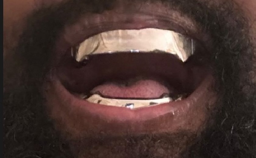 Kanye West coloca prótese de titânio de R$ 4 milhões nos dentes