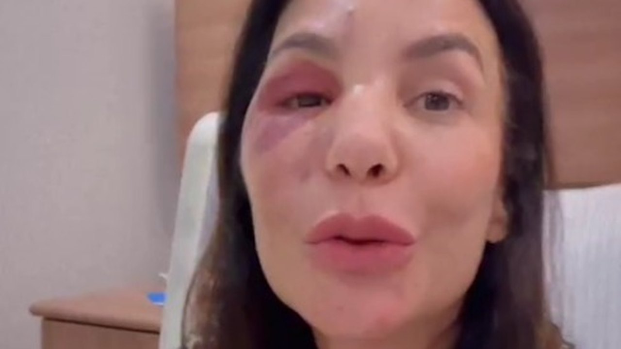 Famosos manifestam apoio a Ivete Sangalo após cantora detalhar lesão grave no rosto