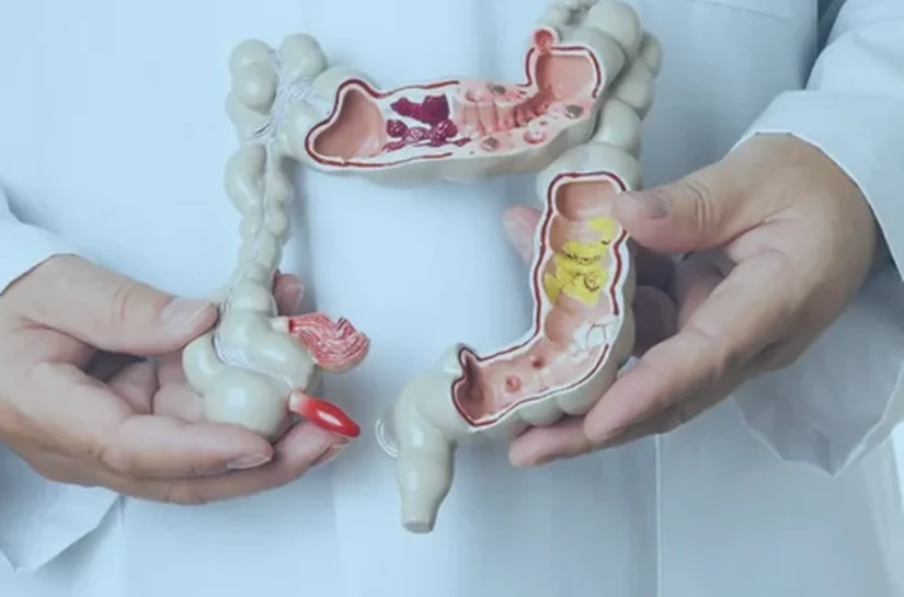 Bactéria intestinal de rãs elimina focos de câncer colorretal em ratos