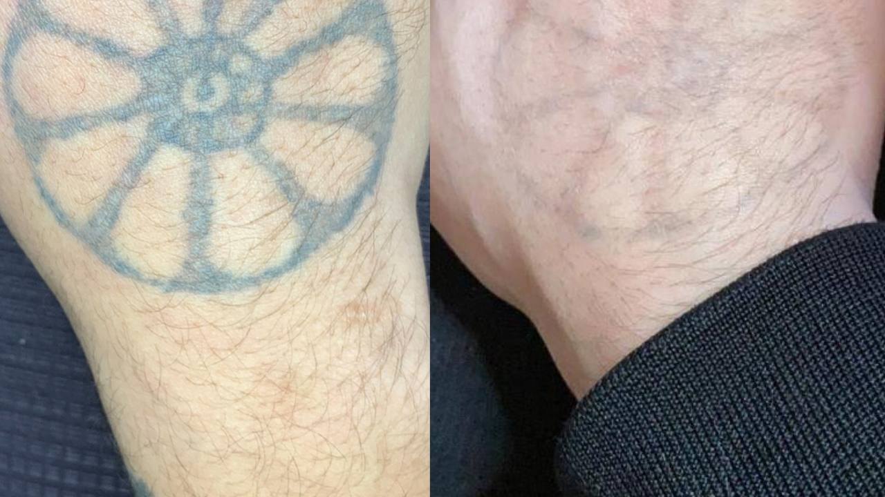 Especialista esclarece dúvidas sobre remoção de tatuagem