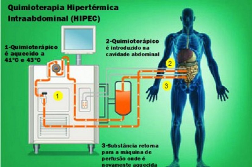 Santa Casa realiza tratamento oncológico após 1 ano de preparativos