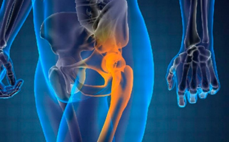 Câncer ósseo mais comum atinge principalmente crianças e adolescentes