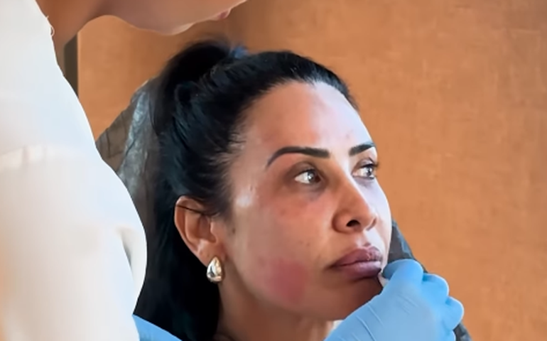 Scheila Carvalho remove procedimentos estéticos e web reage: 'Irreconhecível'