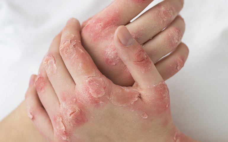 Psoríase ainda é cercada de estigmas e exige diagnóstico precoce, alertam dermatologistas do CEJAM