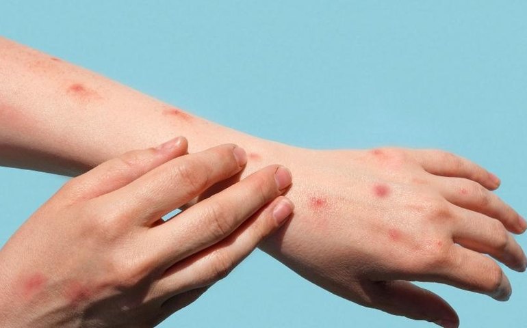 OMS: é improvável que surto de varíola dos macacos se transforme em pandemia