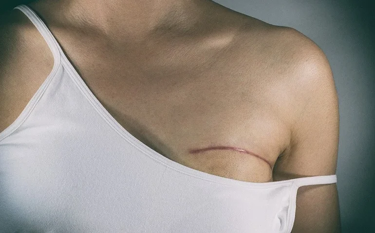 Lei garante fisioterapia no SUS a pacientes que retirarem mama