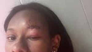 Estudante é acusada injustamente e agredida com mordidas no rosto em Carmópolis