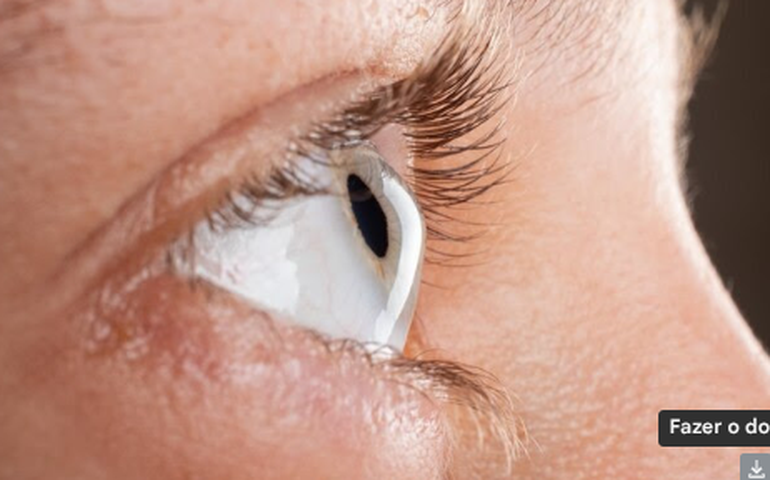 4 fatores de risco para o Ceratocone, entre eles coçar os olhos