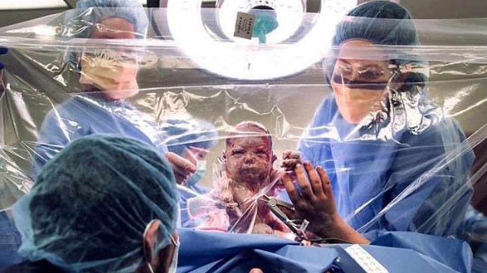 Cortina transparente permite que mães em parto cesáreo acompanhem procedimento