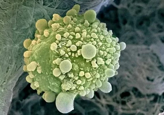 Vacina de RNA tem bons resultados contra câncer de pâncreas, diz estudo